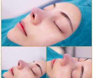 Mũi bị nổi cục sau khi nâng là hiện tượng hiếm gặp