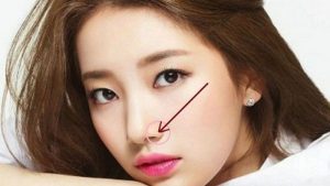 Cắt cánh mũi giúp cho mũi thon gọn đẹp mọi góc nhìn