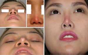 Dấu hiệu nhận biết tụt sụn mũi sau nâng là gì ?