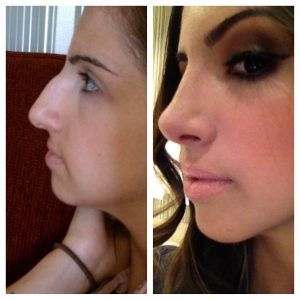 Mũi của bạn sẽ dần thon gọn, vào form như mong muốn