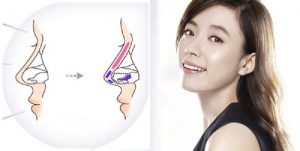 Nâng mũi là giải pháp khắc phục dáng mũi bên to bên nhỏ