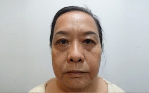 Biến chứng cắt mí dưới bị lật