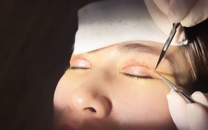 Cắt chỉ đơn giản, không gây đau