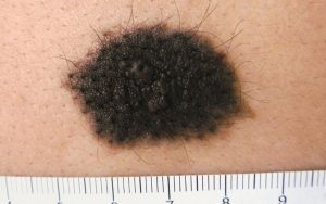 bớt đen bẩm sinh có lông