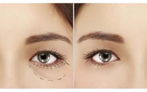 lấy mỡ mí mắt