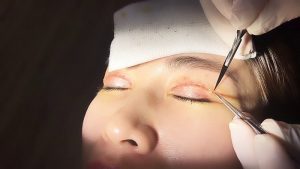 7 – 10 ngày sau khi cắt mí có thể cắt chỉ cho mắt