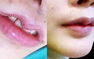 Cắt môi trái tim bị hở răng là biến chứng do thực hiện sai kỹ thuật