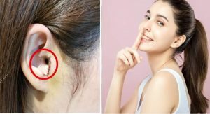 Nâng mũi bằng sụn tai có bị teo lại không