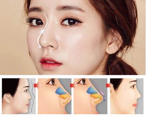 Quá trình nâng mũi diễn ra nhanh chóng và an toàn