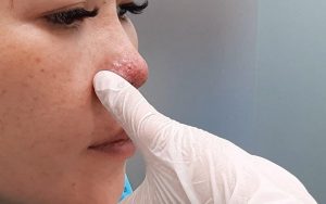 Nâng mũi cấu trúc giúp tái tạo toàn bộ cấu trúc mũi