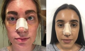 Tình trạng nâng mũi bị sưng mắt có thể xuất phát từ nhiều nguyên nhân