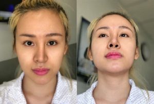 Sụn mũi không tương thích với cơ thể sẽ gây ra nhiều biến chứng, làm mất thẩm mỹ khuôn mặt