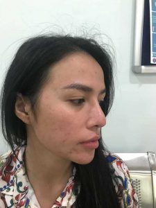 Hiện tượng đỏ đầu mũi sau khi nâng là hiện tượng phổ biến của nhiều người