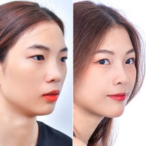 Mũi trở nên cao, thon gọn và thanh thoát hơn rất nhiều sau khi nâng mũi bằng mỡ tự thân