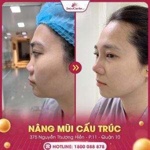 Chi phí nâng mũi cấu trúc bao nhiêu sẽ còn phụ thuộc vào địa chỉ mà bạn thực hiện