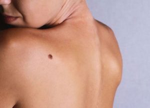 Nốt ruồi ở lưng phụ nữ và đàn ông ý nghĩa gì? Tốt hay xấu?