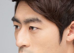 Tướng mũi gãy có phần xương sống mũi lồi lên rõ ràng trông rất mất thẩm mỹ