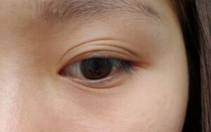 Mắt có nhiều đường lằn mí xếp chồng lên nhau không rõ nếp