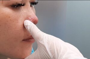 Mũi bị sưng lâu không thuyên giảm có thể là dấu hiệu mũi nhiễm trùng