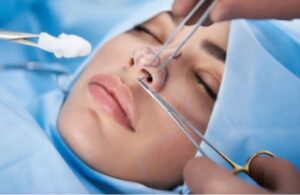 Nâng mũi bằng sợi sinh học PDO có ưu điểm nhanh có dáng mũi như ý