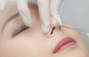 Nâng mũi bằng chỉ có chi phí hợp lý, không cần xâm lấn sâu