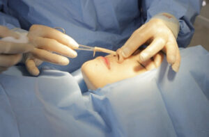 Tỷ lệ tụt sụn sau nâng mũi chiếm dưới 2%