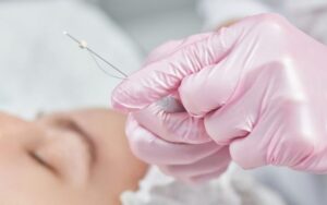 Căng chỉ nâng mũi là phương pháp làm đẹp được nhiều khách hàng ưa chuộng hiện nay