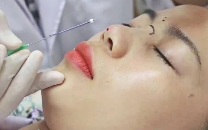 Căng chỉ nâng mũi chỉ phù hợp với một số đối tượng nhất định