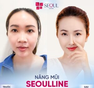 Cần lựa chọn những địa chỉ nâng mũi không bọc đầu mũi uy tín, chất lượng