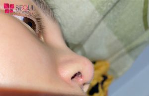 Nâng mũi bị vết thương hở là tình trạng da mũi bị thủng nhìn thấy sụn