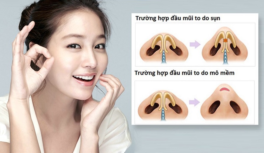 Tùy từng trường hợp mà có thể áp dụng công nghệ thu gọn đầu mũi hiệu quả