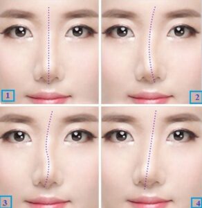 Mũi lệch bắt nguồn từ những nguyên nhân và ảnh hưởng khác nhau