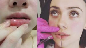 Biến chứng khi sử dụng filler kém chất lượng