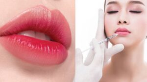 Tiêm filler môi cherry giúp đôi môi đầy đặn, quyến rũ