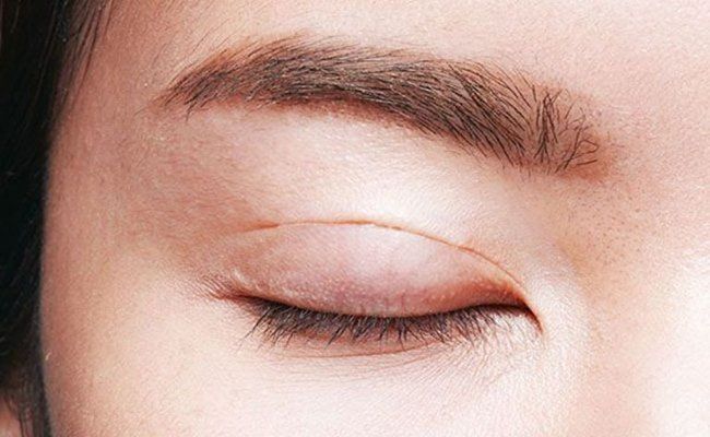 Phù nề sau phẫu thuật là phản xạ miễn dịch tự nhiên giúp bảo vệ và tự chữa lành vết thương.