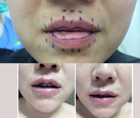 Phẫu thuật cắt môi trề kéo dài 30–45 phút, thường ứng dụng công nghệ dao phẫu hoặc laser bóc tách mô niêm mạc chuẩn xác và khâu đóng thẩm mỹ bằng chỉ tự tiêu.