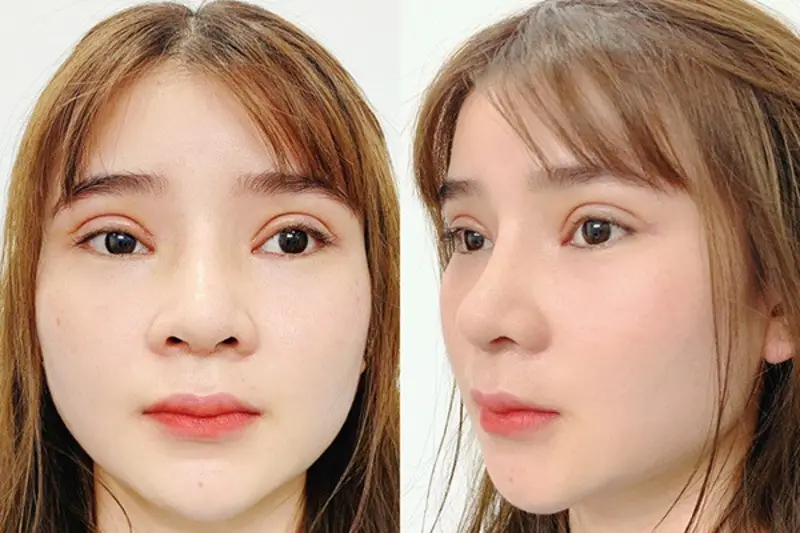 Từ 1 đến 3 tháng sau cắt mí, nếp mí sẽ mềm mại và vào form tự nhiên hơn dù đường sẹo vẫn còn hơi hồng.
