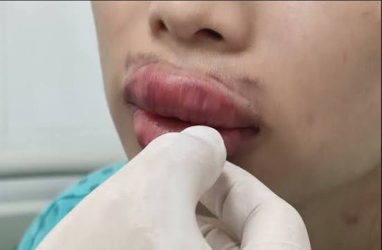 Sưng môi sau tiêm filler là phản xạ viêm tự nhiên giúp cơ thể thích ứng và ổn định chất làm đầy.