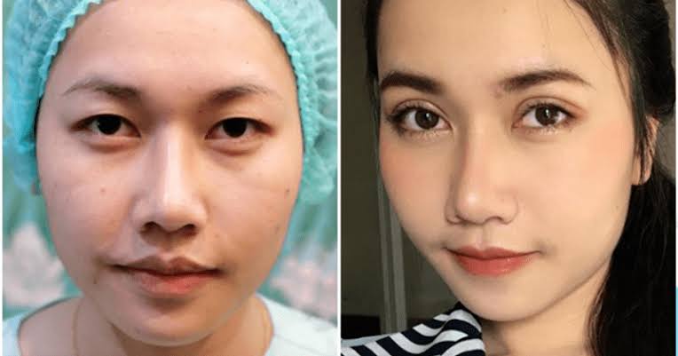 Kết quả cắt mí thường duy trì được 10–15 năm trước khi mờ dần do quá trình lão hóa da tự nhiên.