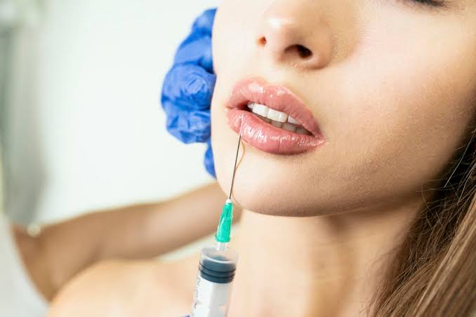 Filler môi tự phân hủy sinh học và đào thải tự nhiên trong khoảng 6 đến 18 tháng tùy cơ địa mỗi người.