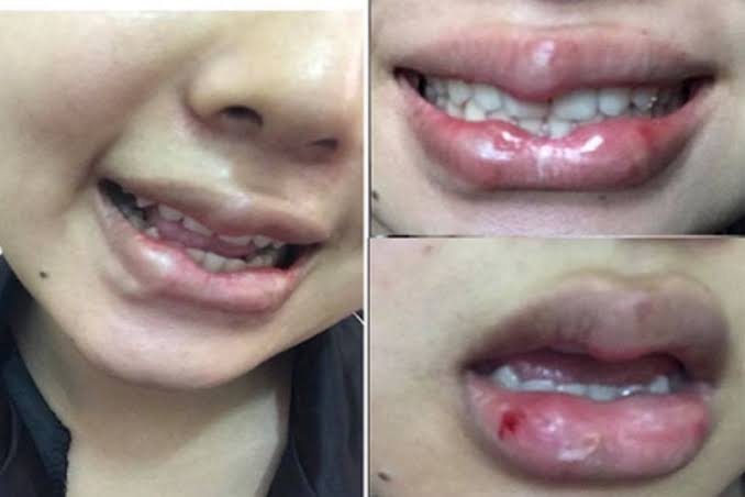 Sẹo lồi do di truyền, cần báo trước bác sĩ để chủ động phòng ngừa.