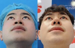 Thu gọn cánh mũi có đau không: cảm giác thực tế từ bác sĩ