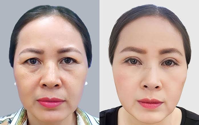 Cắt mí dưới là tiểu phẫu ít xâm lấn, gây tê tại chỗ giúp khắc phục khuyết điểm mắt với vết sẹo giấu sát bờ mi.