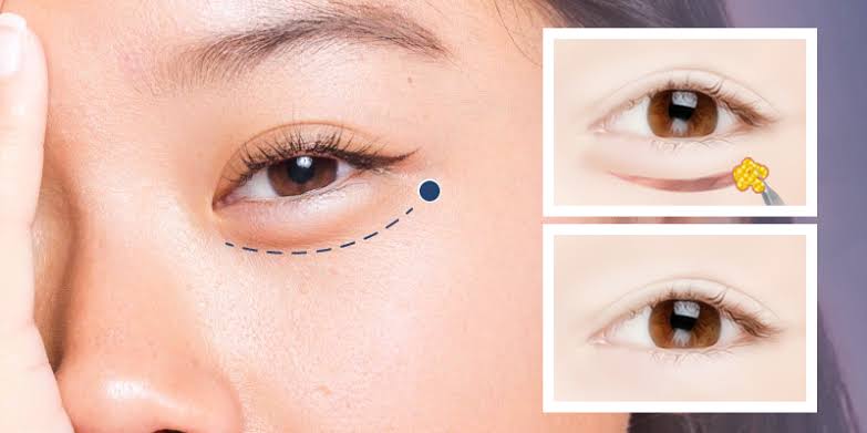 Lợi ích của cắt mí dưới giúp xóa bọng mắt, giảm thâm nhăn, cải thiện tầm nhìn và trẻ hóa diện mạo tổng thể.