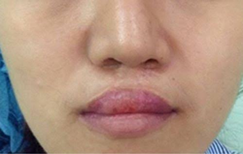 Biến chứng do sai kỹ thuật gồm nhiễm trùng, sẹo co rút, lệch môi, hở lợi và tổn thương cơ vòng miệng ảnh hưởng nghiêm trọng đến khả năng phát âm, ăn nhai.