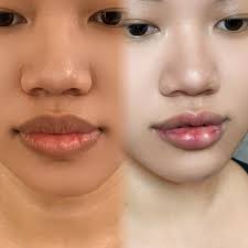 Cắt môi trề là tiểu phẫu loại bỏ mô thừa từ bên trong niêm mạc miệng, giúp tạo hình môi cân đối tự nhiên và hoàn toàn không để lại sẹo lộ bên ngoài.