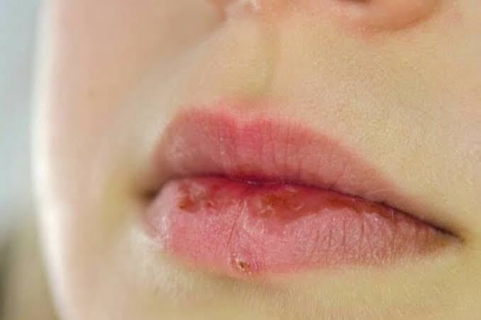 Môi sưng kéo dài trên 72 giờ hoặc bầm đen lan rộng là dấu hiệu cảnh báo xuất huyết dưới da hoặc tắc mạch nguy hiểm cần được xử trí y tế ngay.