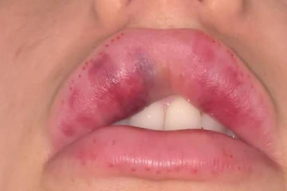 Biến chứng do sai kỹ thuật gồm nhiễm trùng, sẹo co rút, lệch môi, hở lợi và tổn thương cơ vòng miệng ảnh hưởng nghiêm trọng đến khả năng phát âm, ăn nhai.