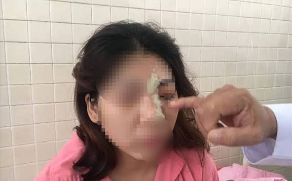 Không nên nâng mũi ở tuổi 14 vì xương sụn chưa phát triển hoàn thiện, tâm lý chưa chín chắn và chưa đủ tuổi pháp lý.