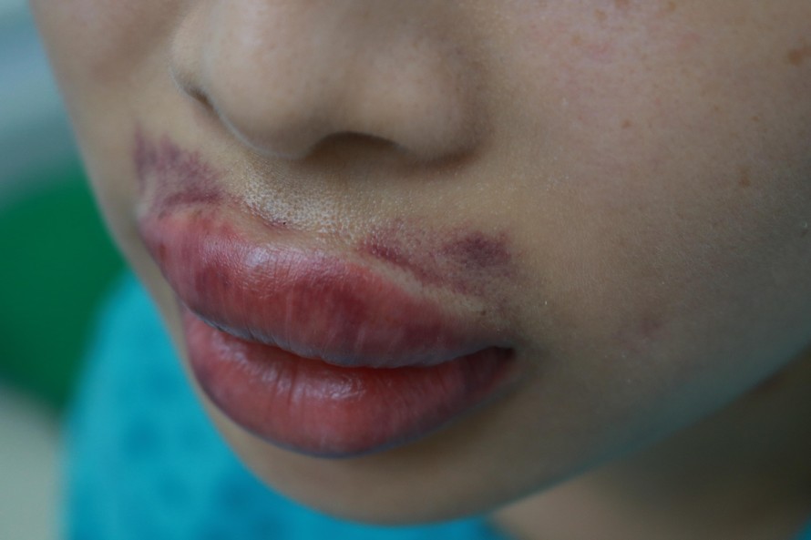 Dưới 18 tuổi tiêm filler có nguy cơ sưng, viêm và biến dạng cao gấp 2–3 lần người lớn.